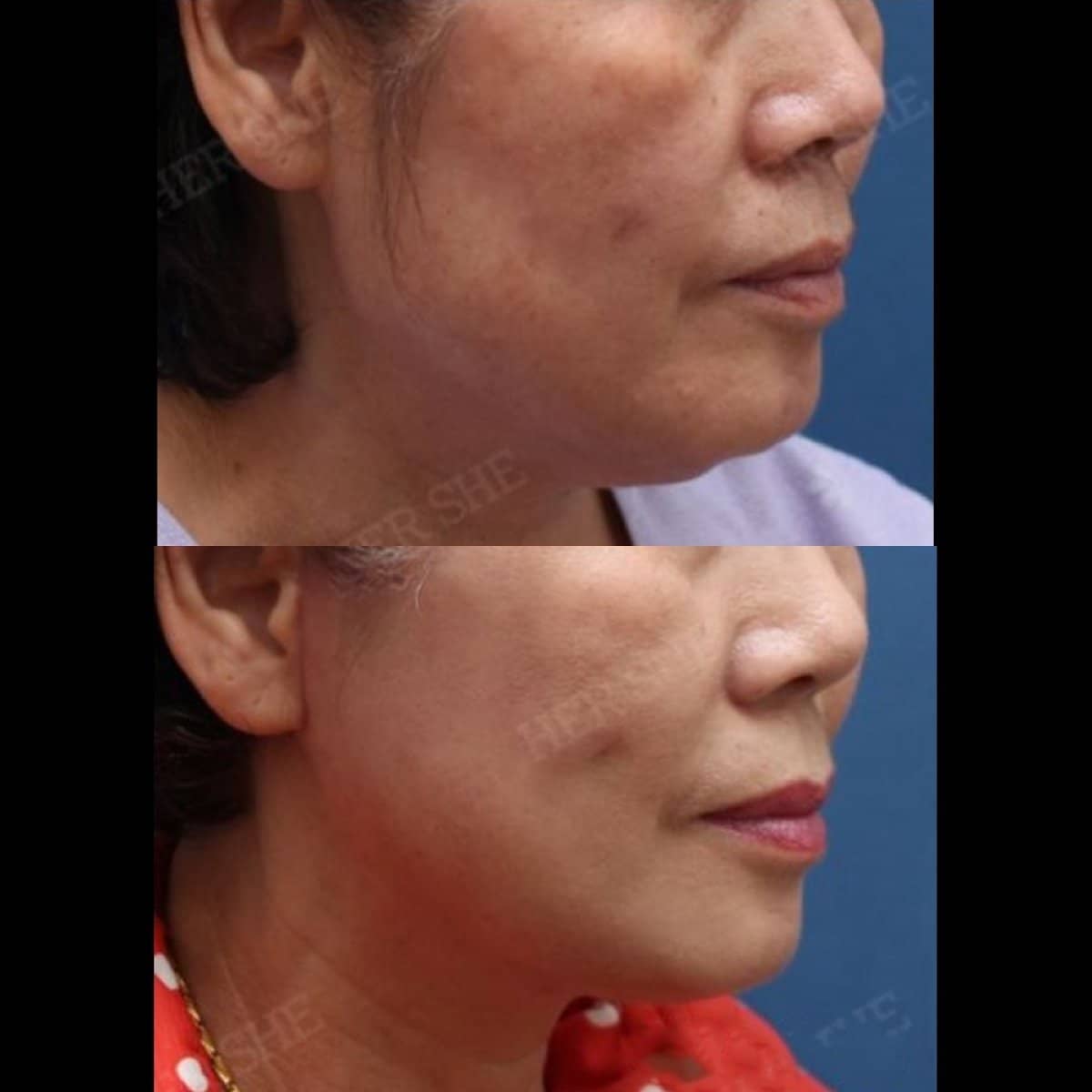 Case 17474 - deep plane facelift