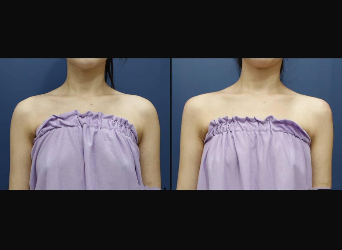 Case 17475 - hyaluronic acid fillers for shoulder contour