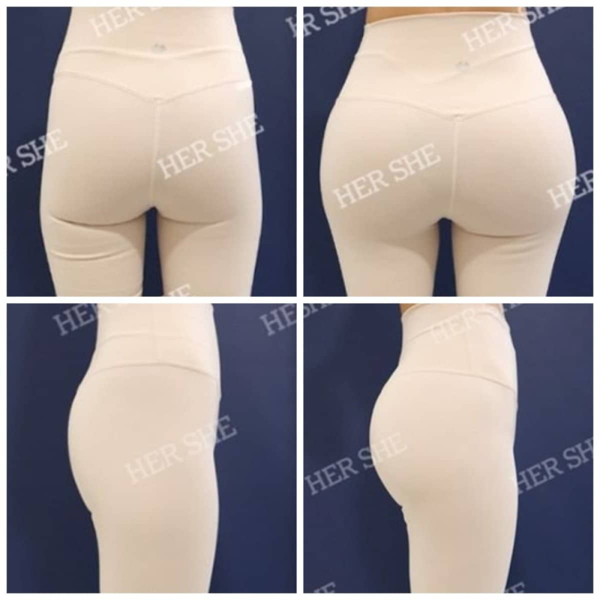 Case 17477 - Brazilian Butt Lift