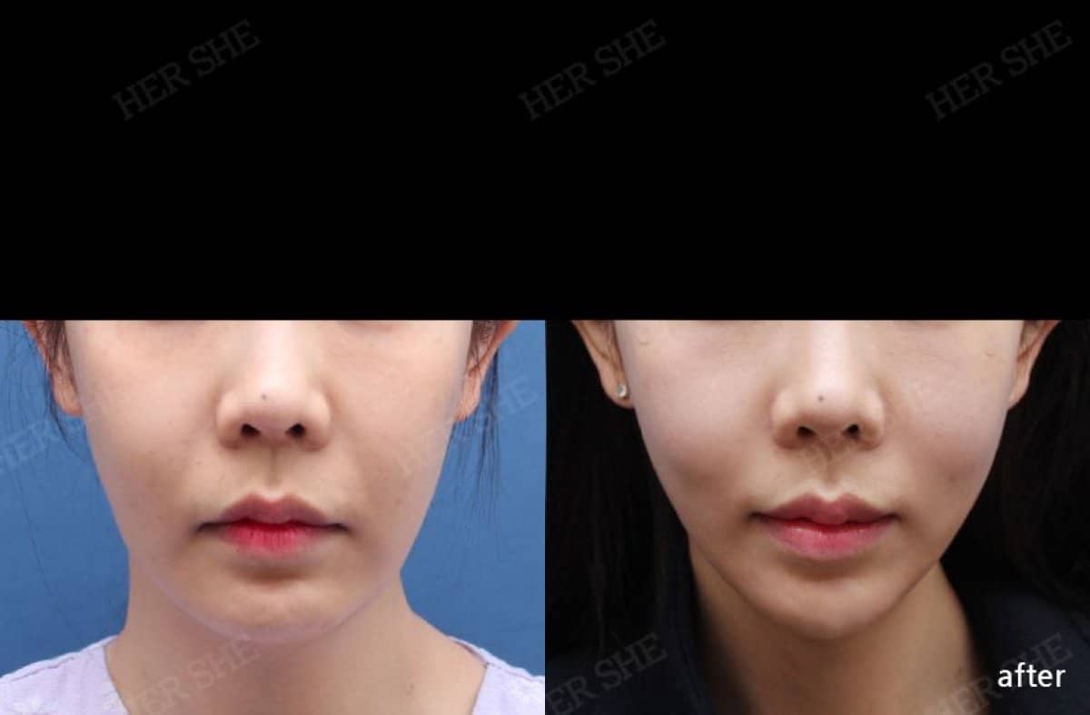 Case 17478 - lipofilling
