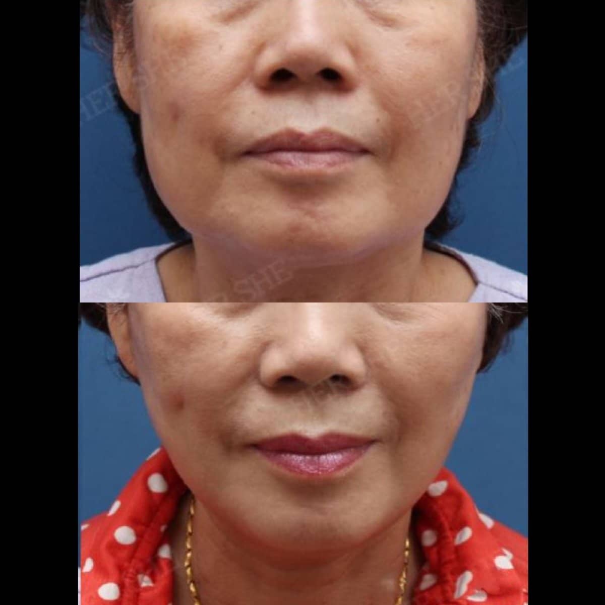 Case 17482 - deep plane facelift