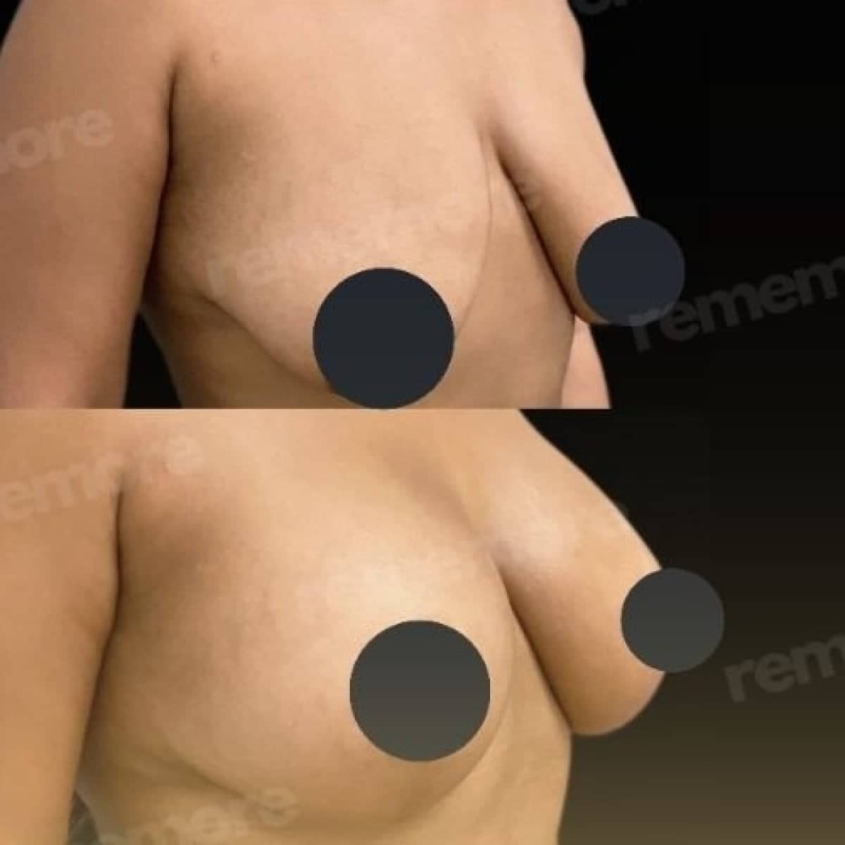 Case 17489 - breast lift