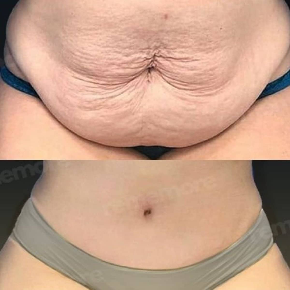 Case 17490 - Vaser liposuction