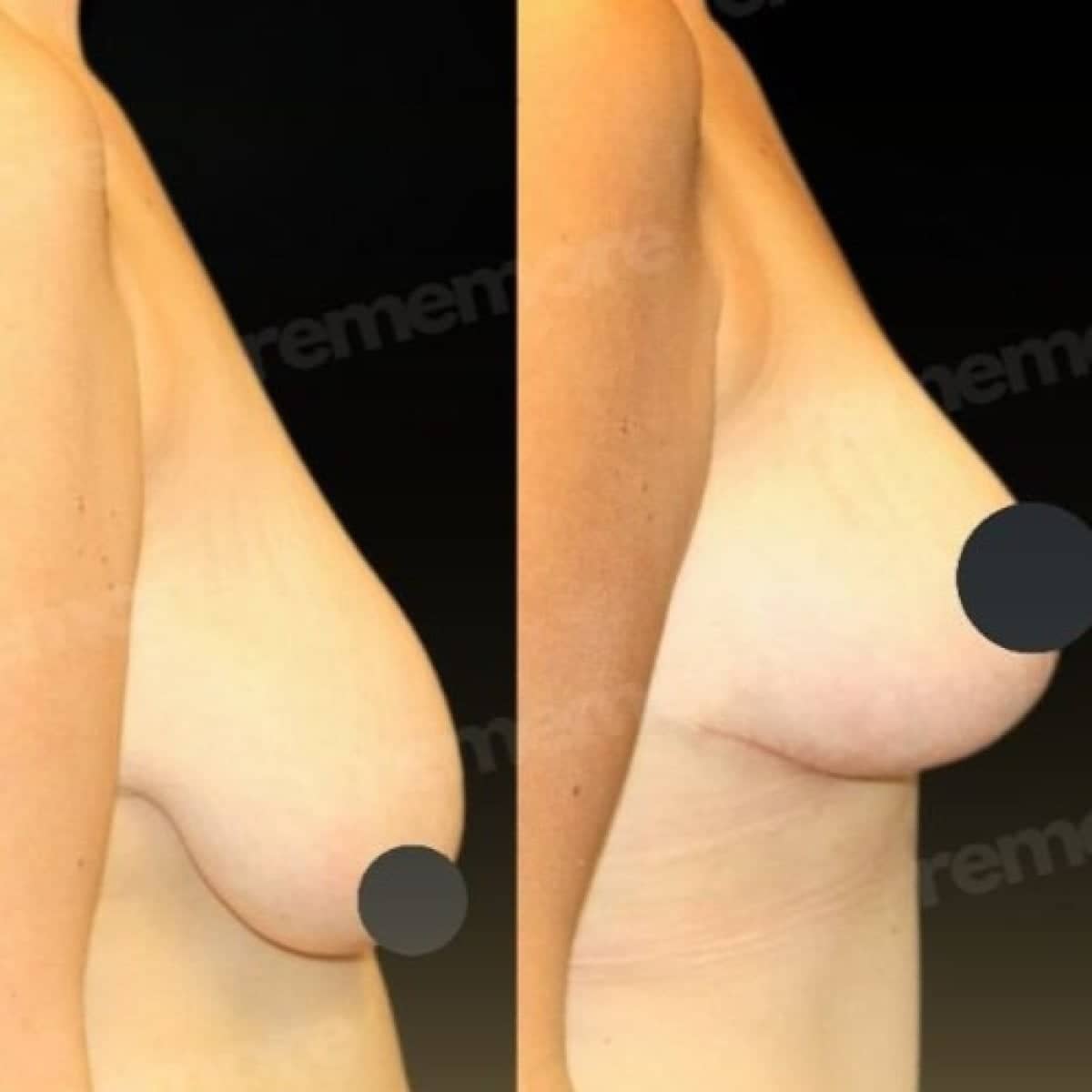 Case 17491 - breast lift