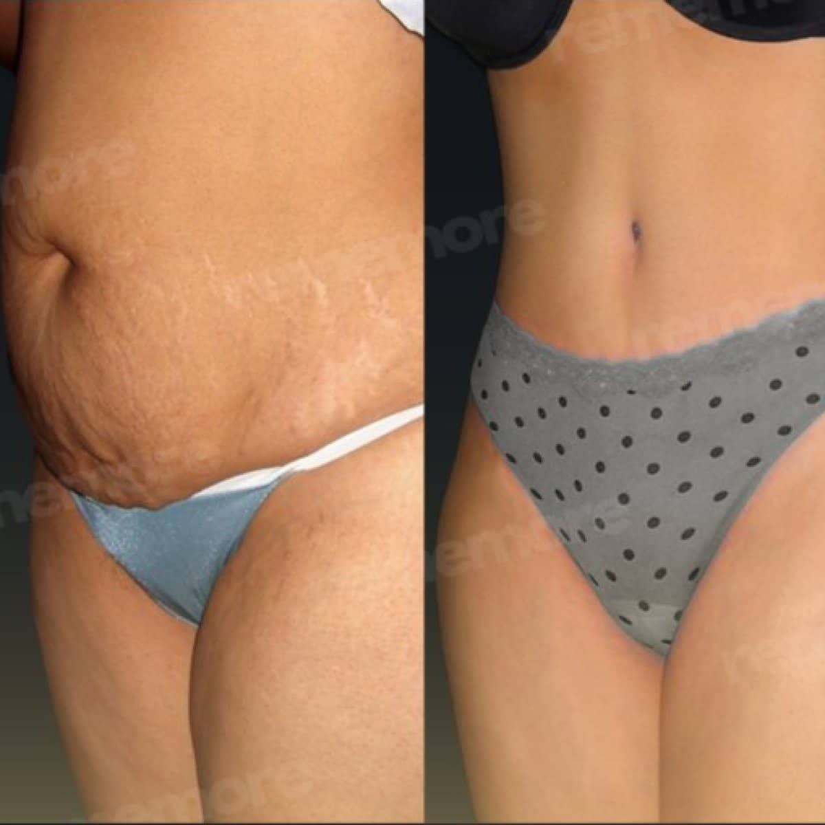 Case 17492 - 360 liposuction