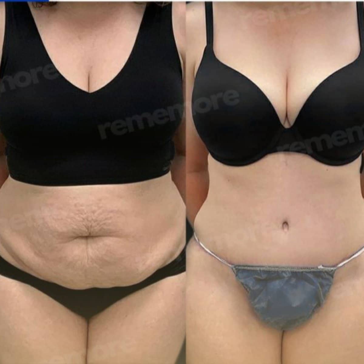 Case 17493 - tummy tuck