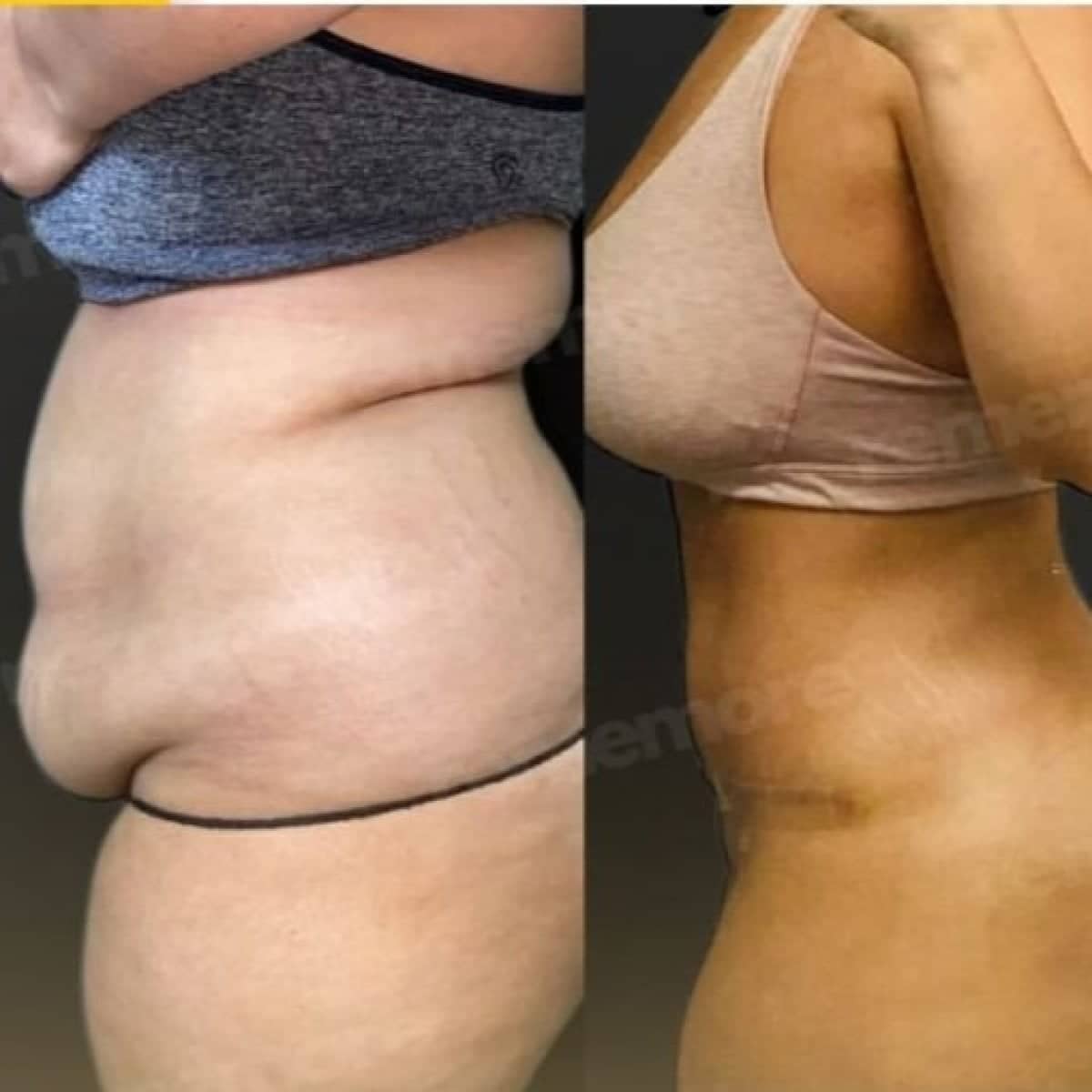 Case 17498 - 360 liposuction