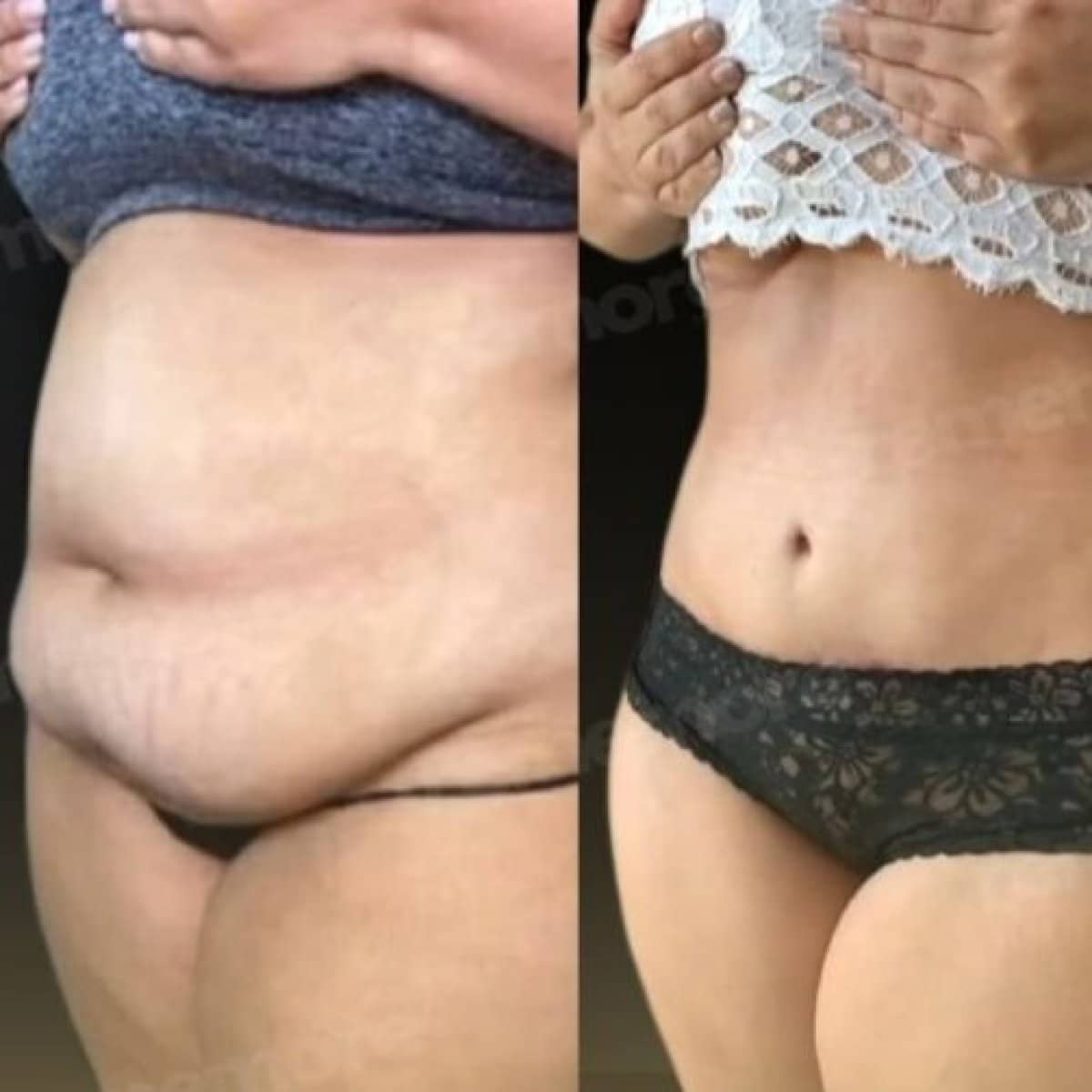 Case 17499 - liposuction
