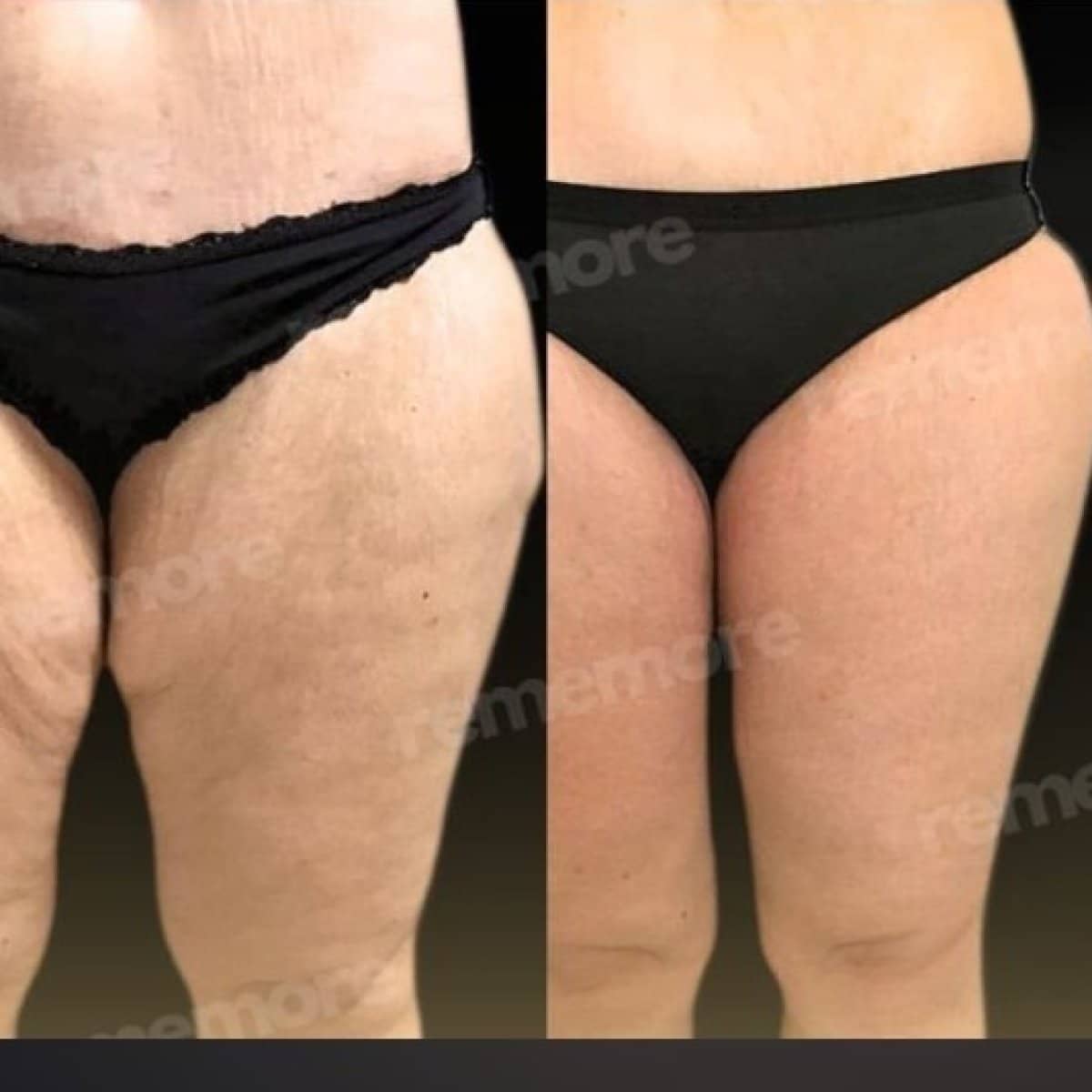 Case 17500 - liposuction