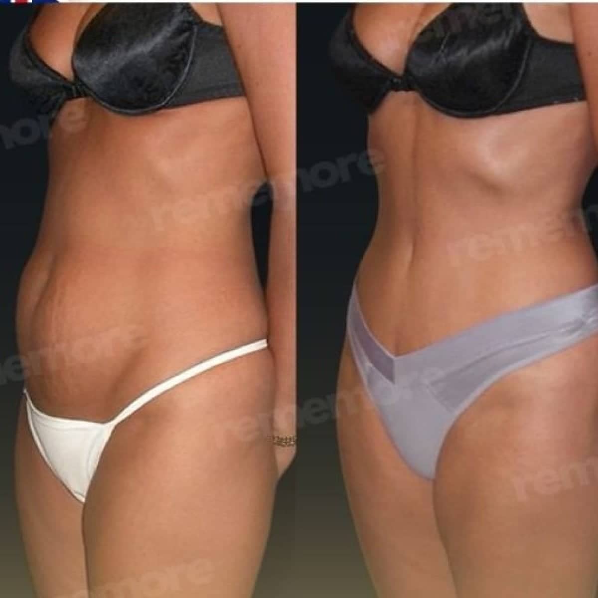 Case 17501 - abdominal liposuction