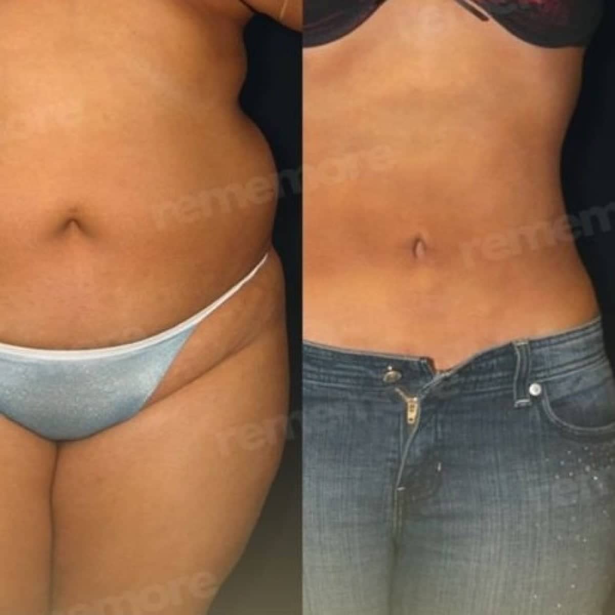 Case 17504 - 360 liposuction