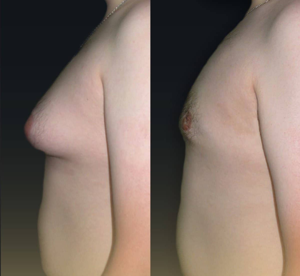 Case 17505 - Vaser liposuction for gynecomastia