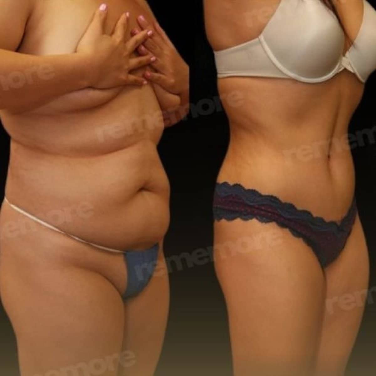 Case 17506 - abdominal liposuction