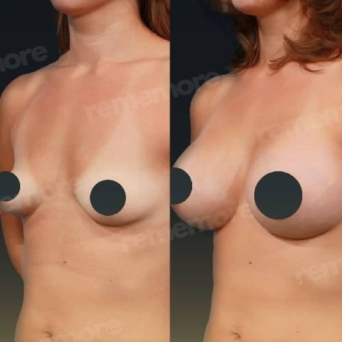 Case 17507 - breast augmentation with fat transfer
