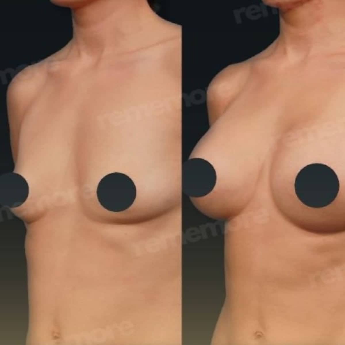 Case 17508 - breast implant revision