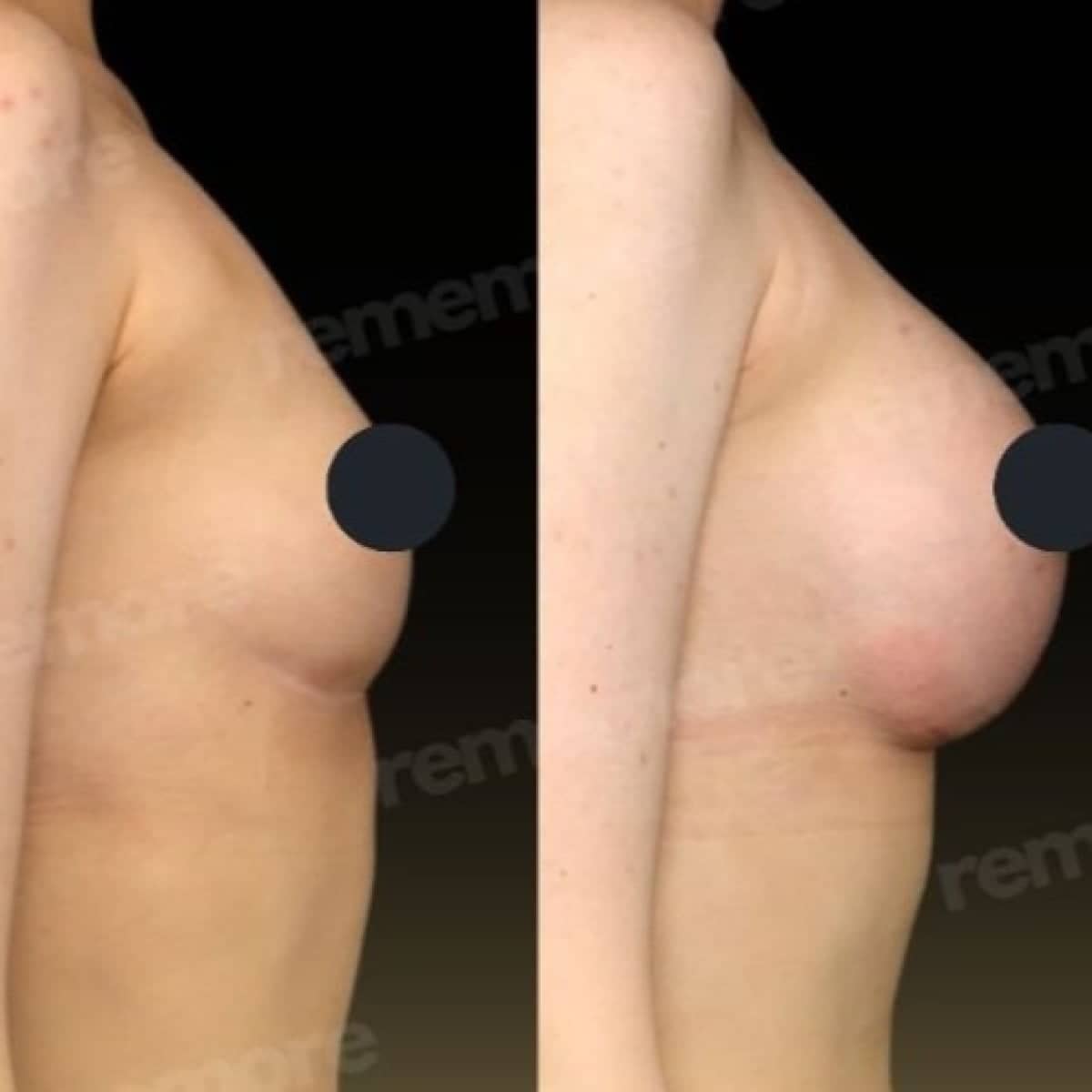 Case 17510 - breast augmentation with fat transfer