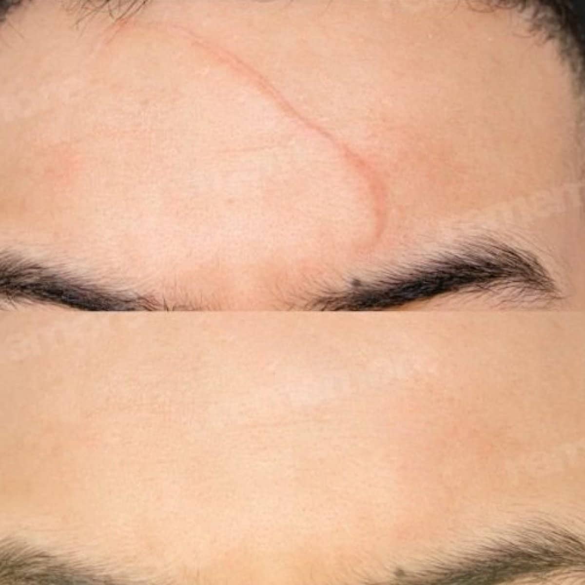 Case 17512 - scar revision