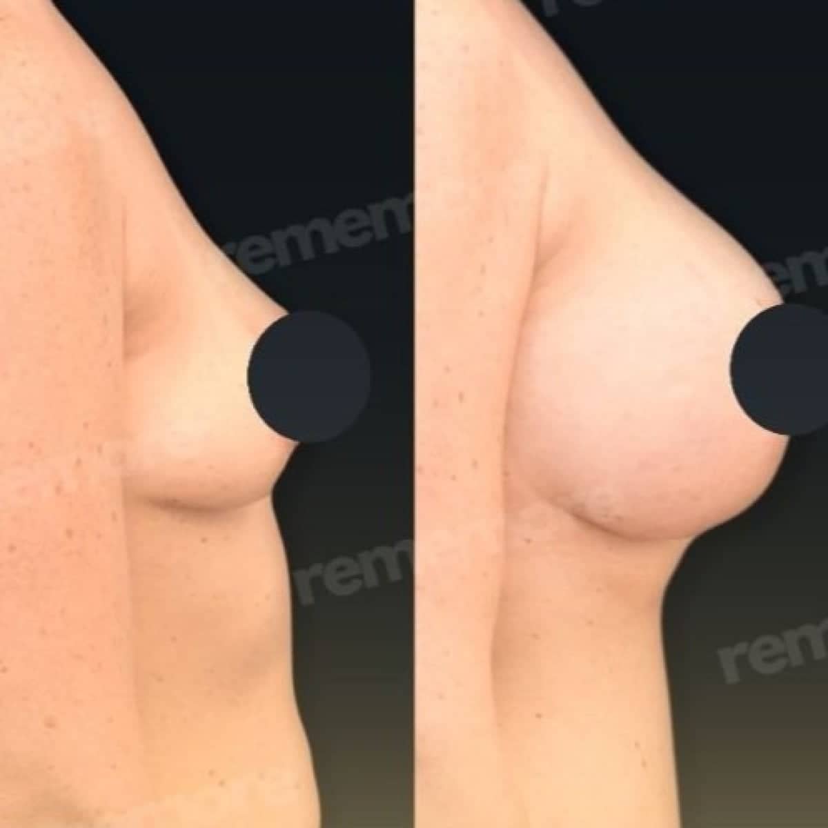 Case 17514 - breast augmentation with fat transfer