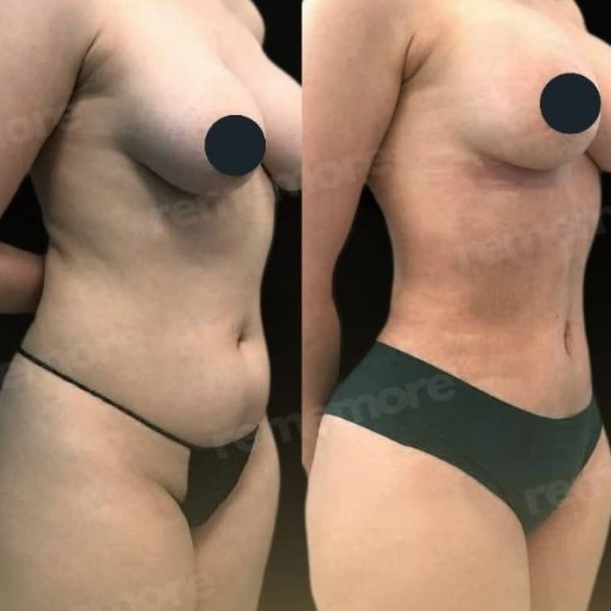 Case 17515 - abdominal liposuction