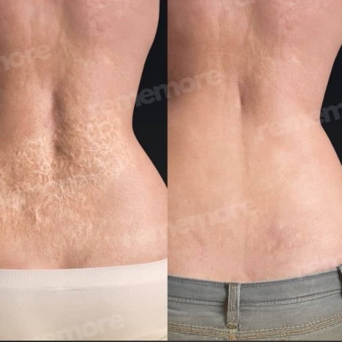 Case 17517 - scar revision