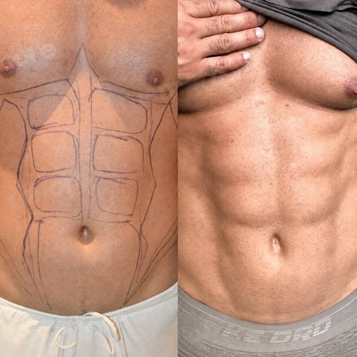 Case 17518 - abdominal etching