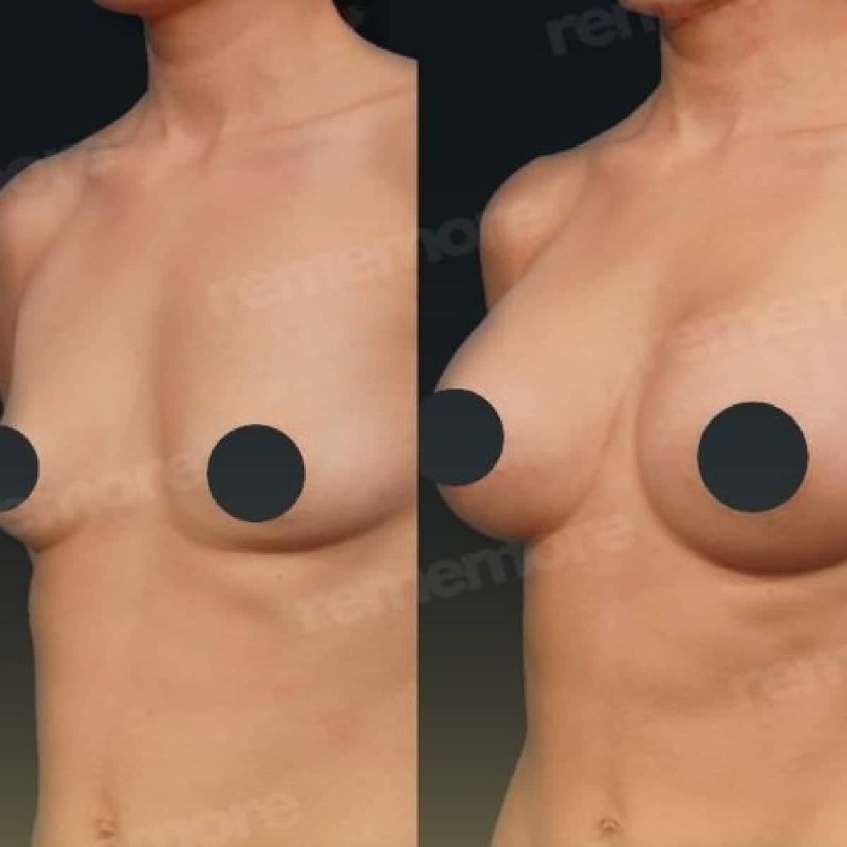 Case 17519 - breast lift