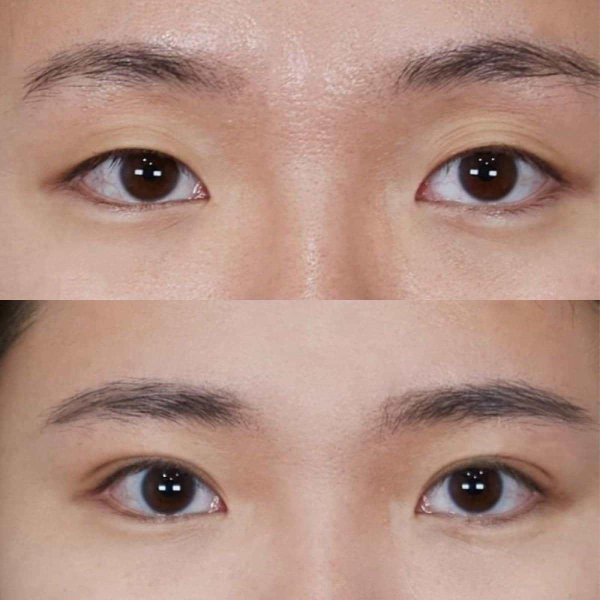 Case 17526 - blepharoplasty