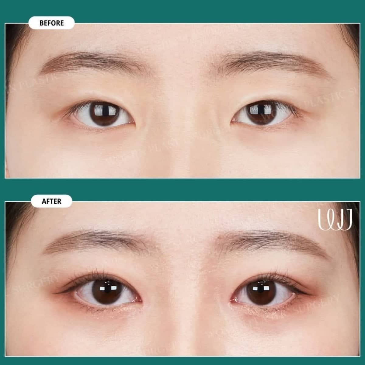 Case 17527 - blepharoplasty
