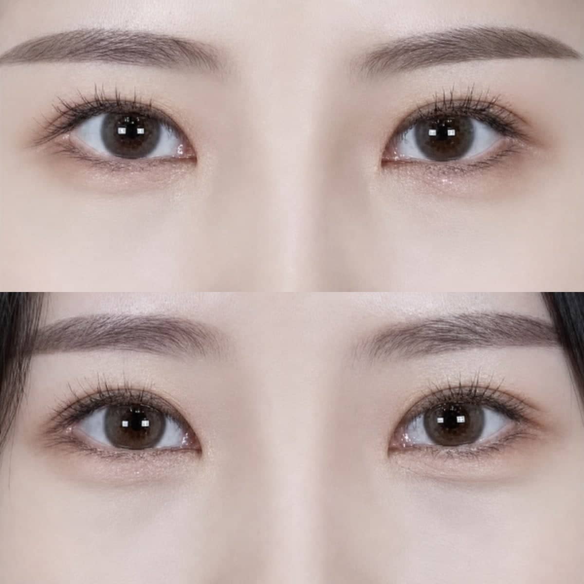 Case 17528 - blepharoplasty