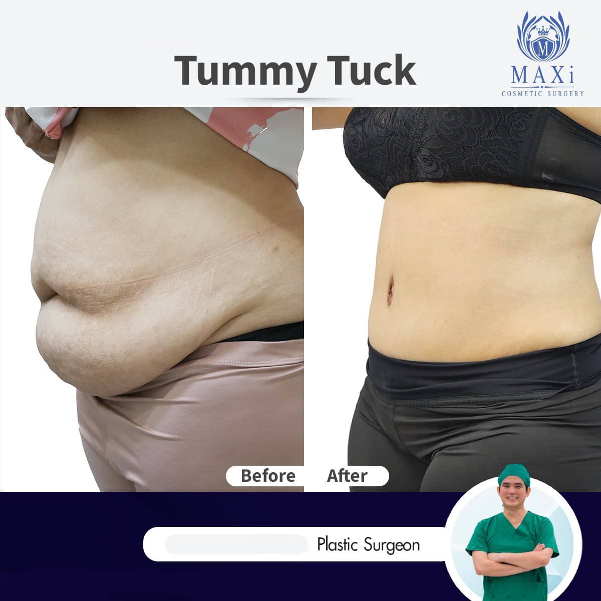 Case 17529 - tummy tuck