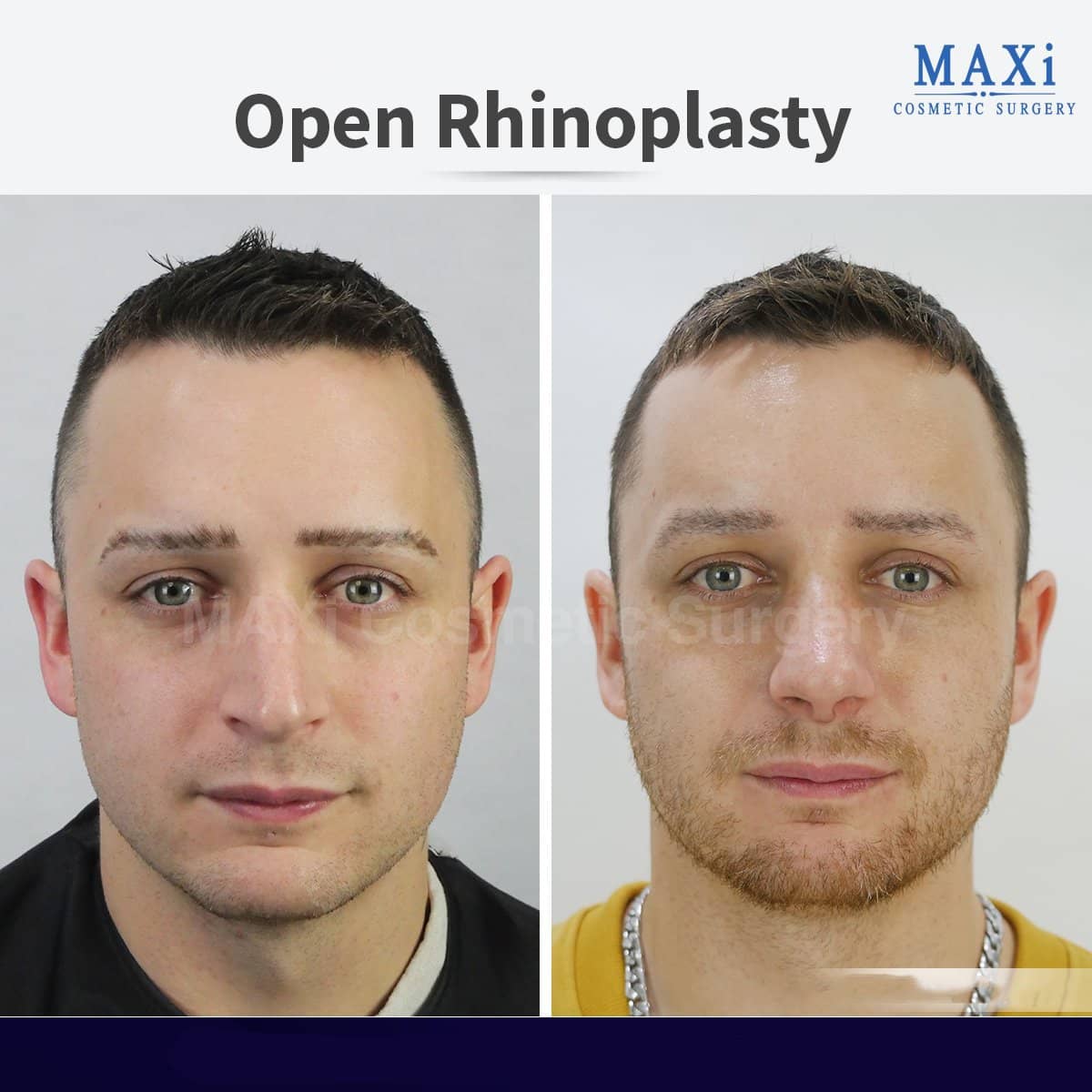 Case 17531 - open rhinoplasty