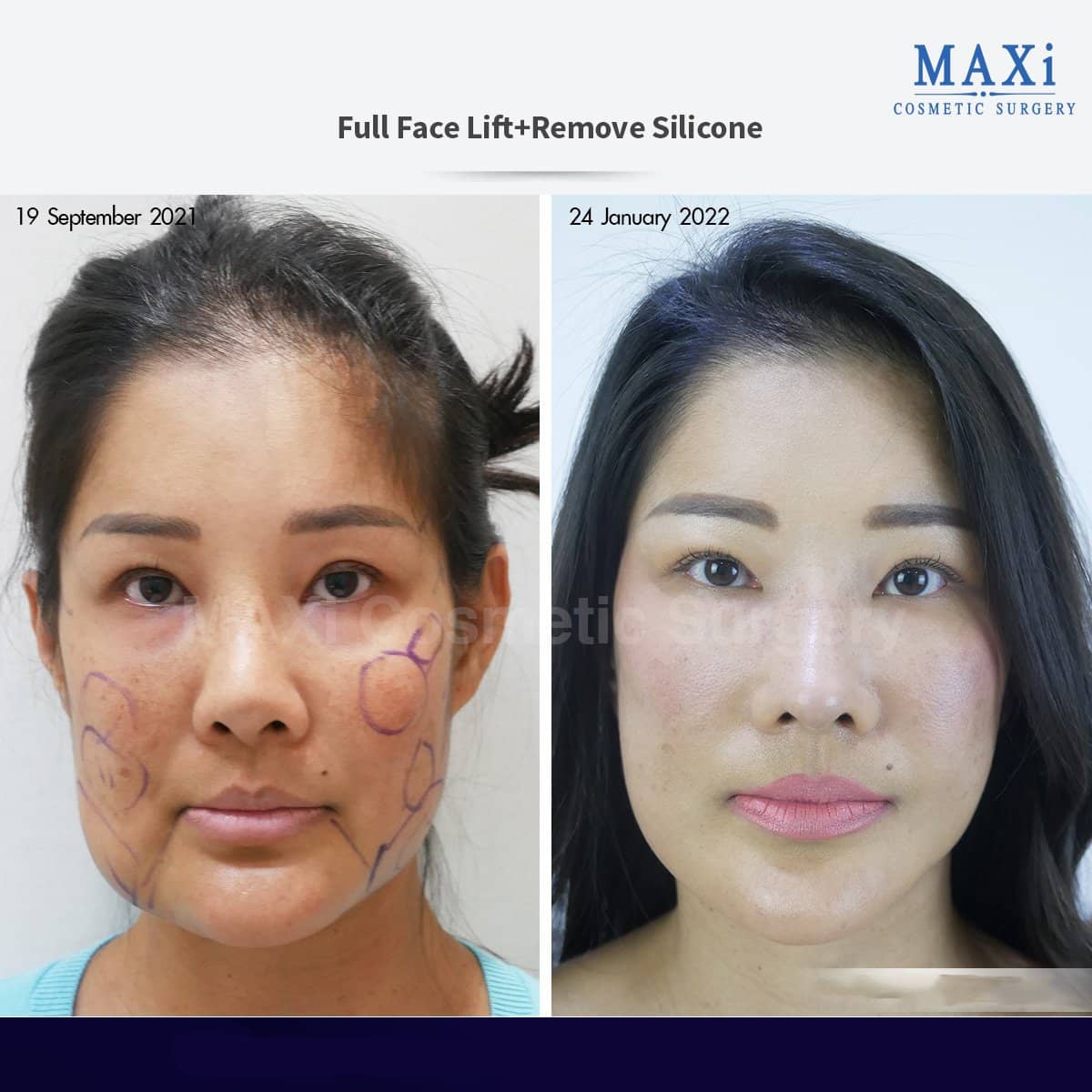 Case 17532 - facelift with silicone removal