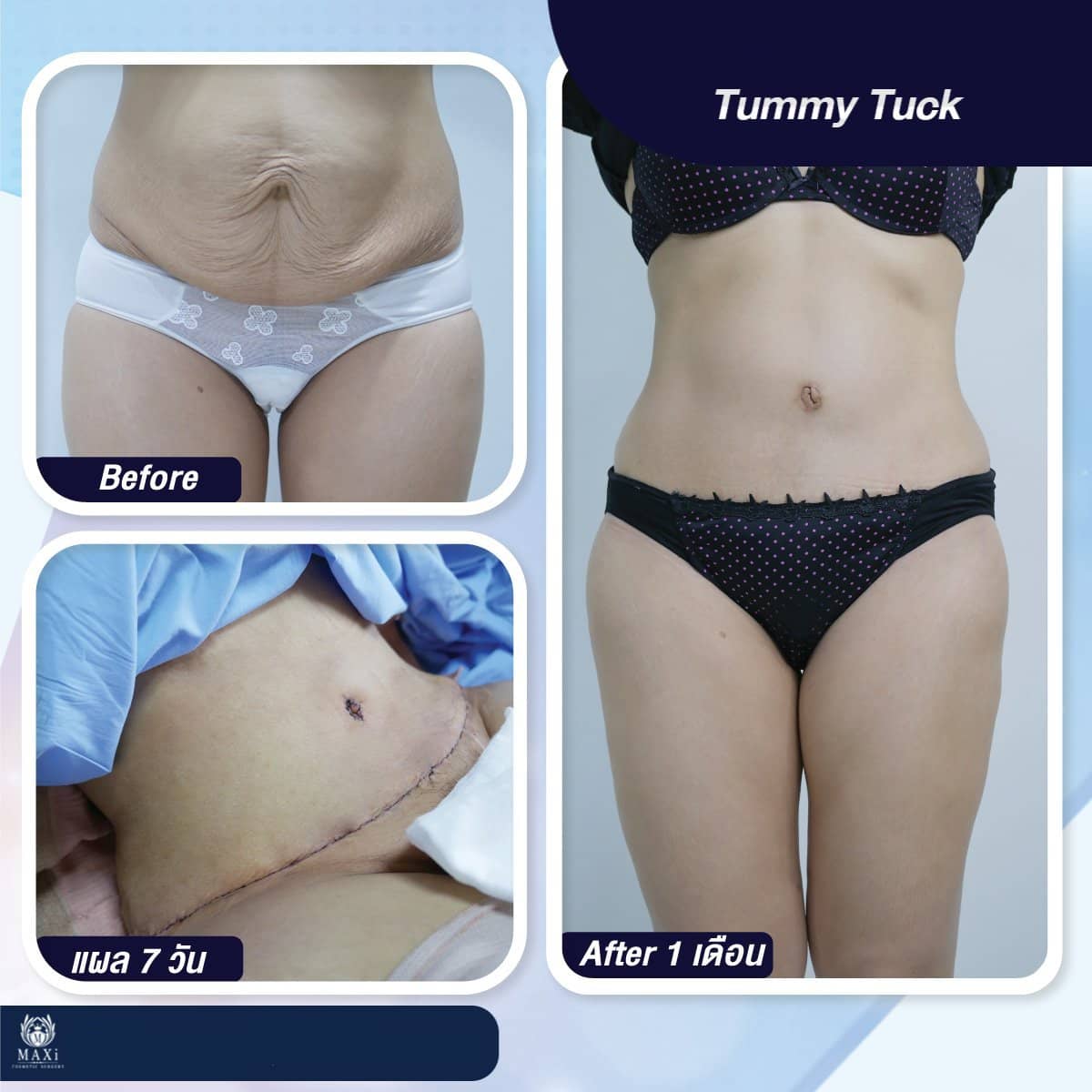 Case 17533 - tummy tuck