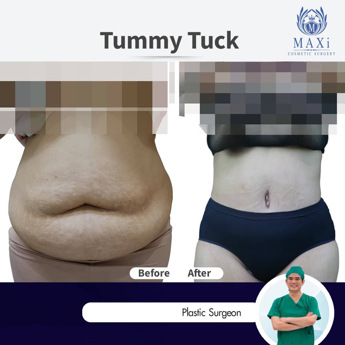 Case 17534 - tummy tuck