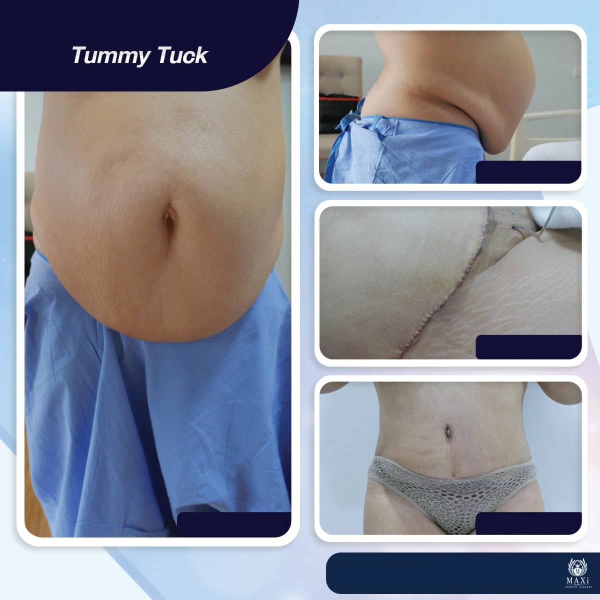 Case 17536 - tummy tuck