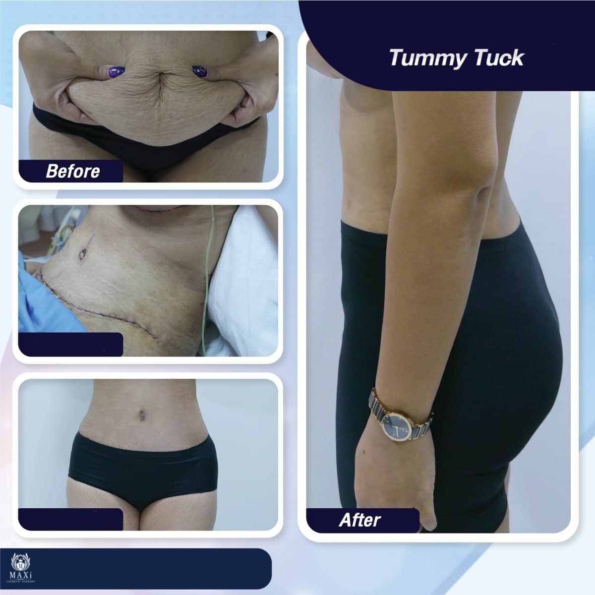 Case 17537 - tummy tuck