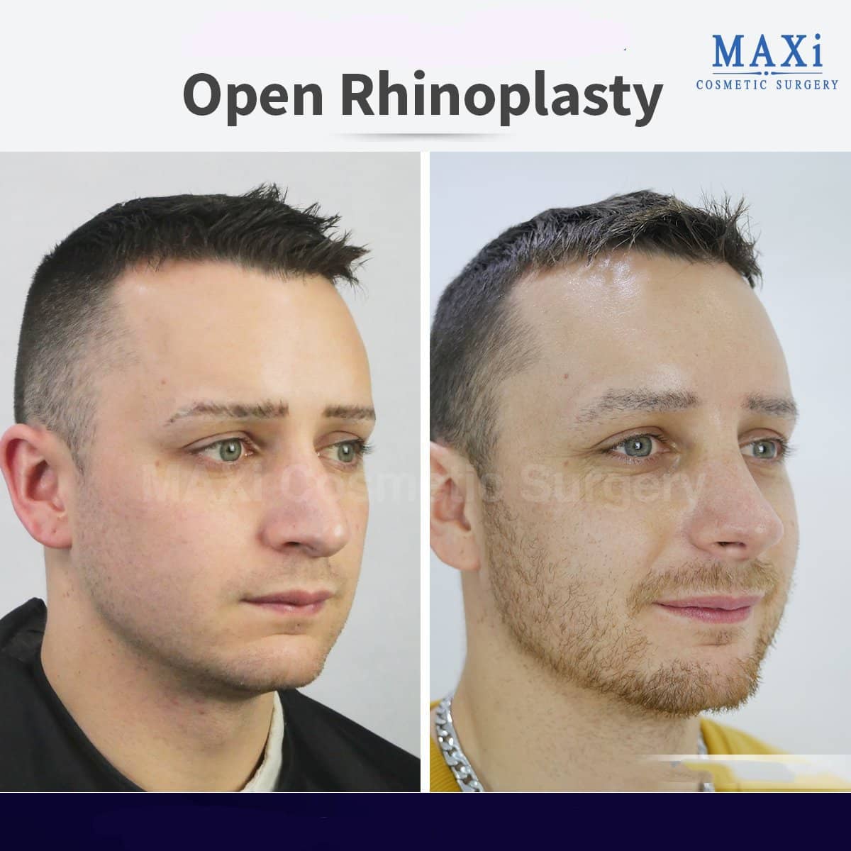 Case 17539 - open rhinoplasty
