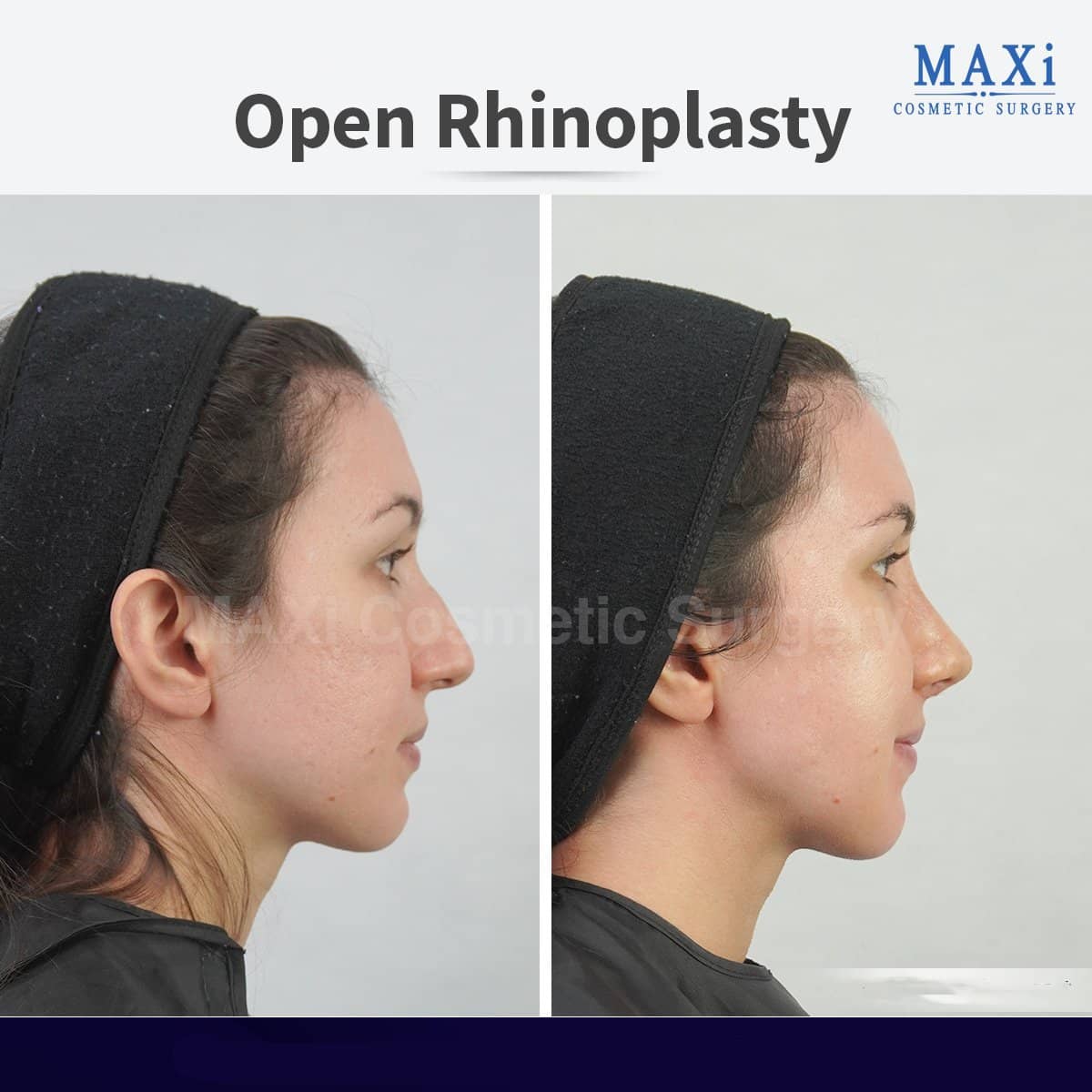 Case 17540 - open rhinoplasty