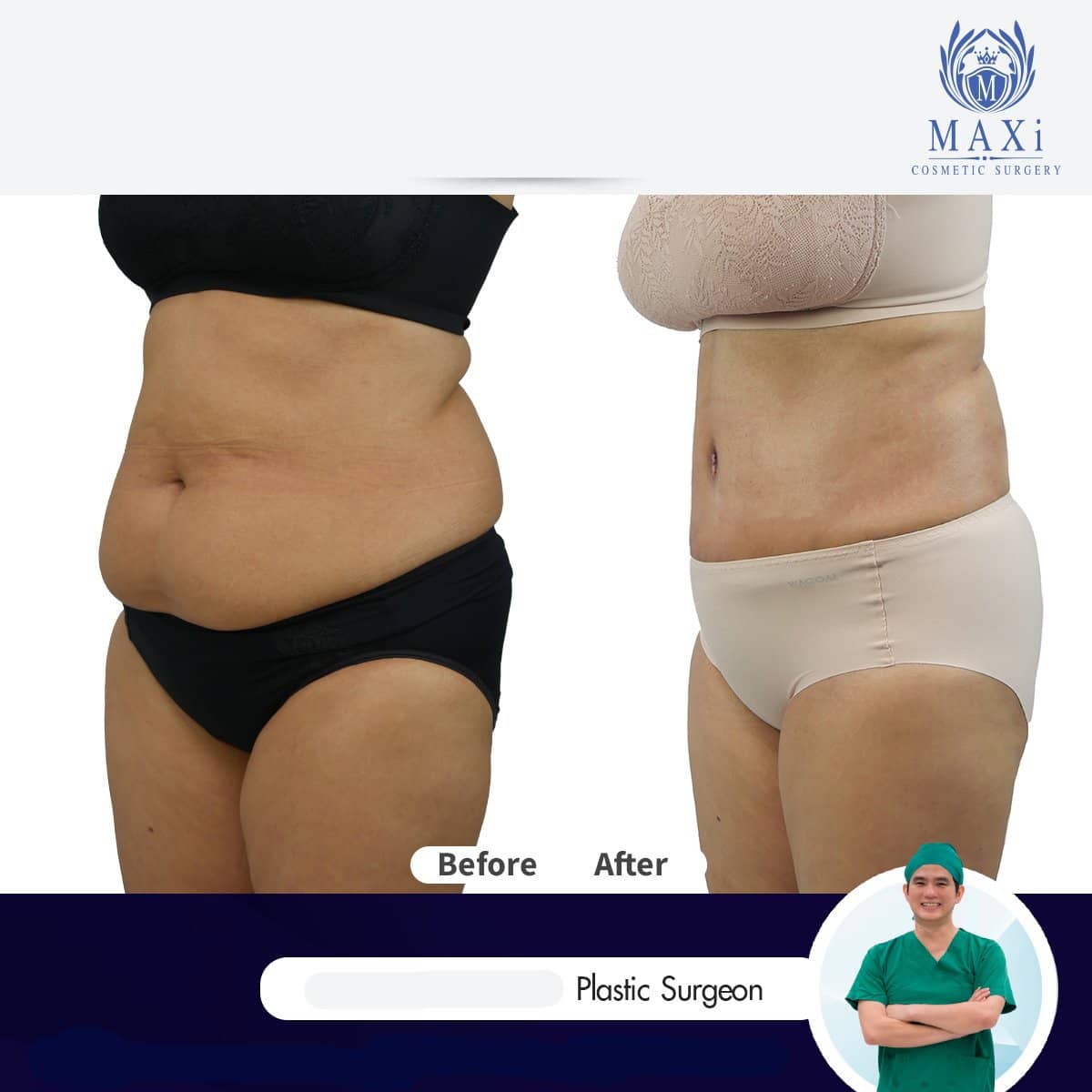 Case 17544 - tummy tuck