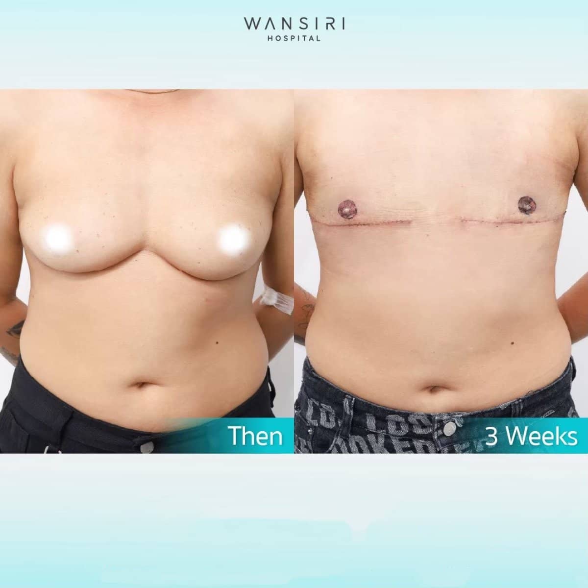 Case 17581 - top surgery