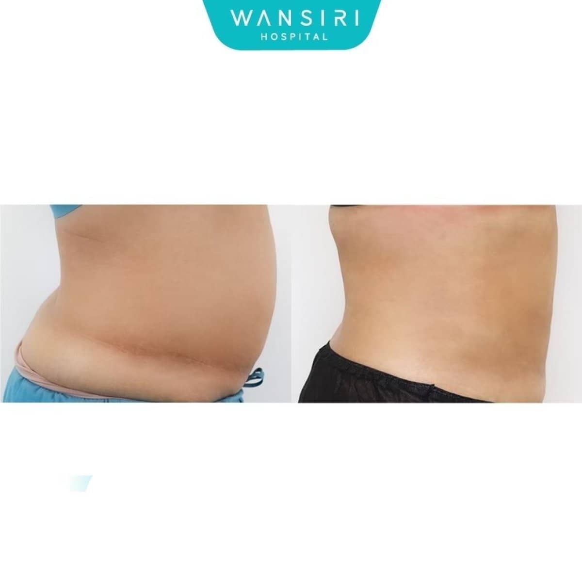 Case 17583 - tummy tuck