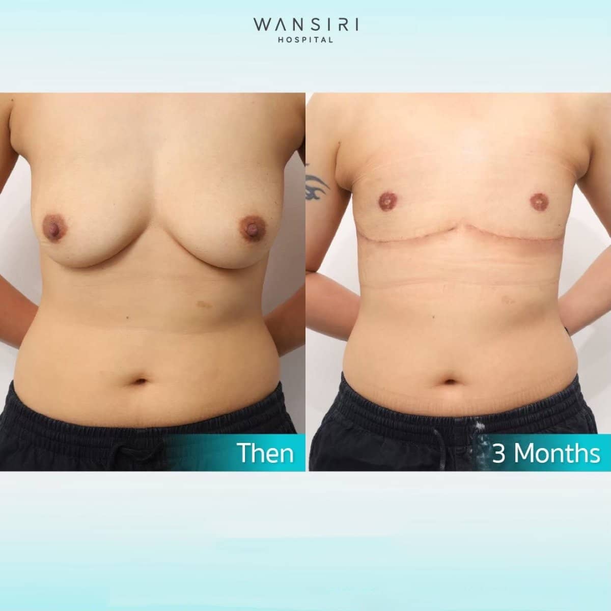 Case 17584 - top surgery