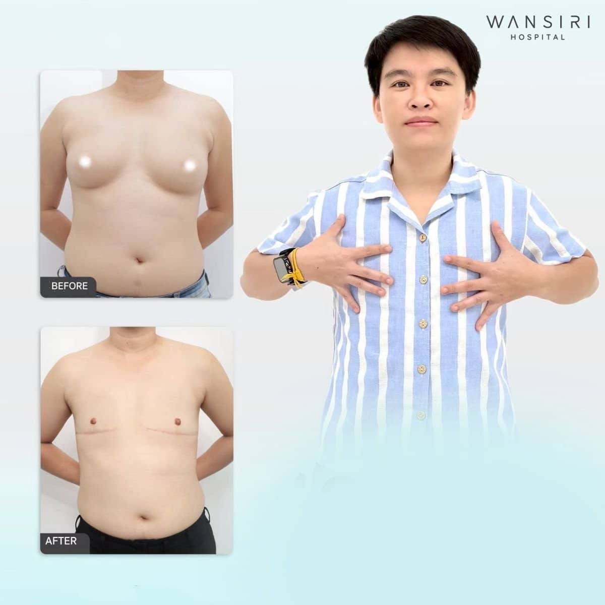 Case 17586 - top surgery
