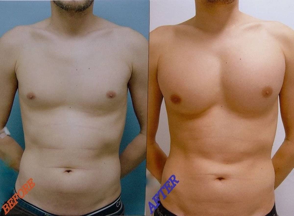 Case 17587 - pectoral implants