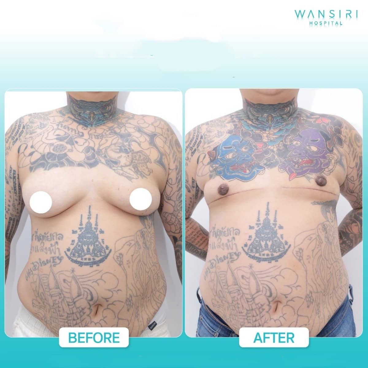 Case 17588 - top surgery