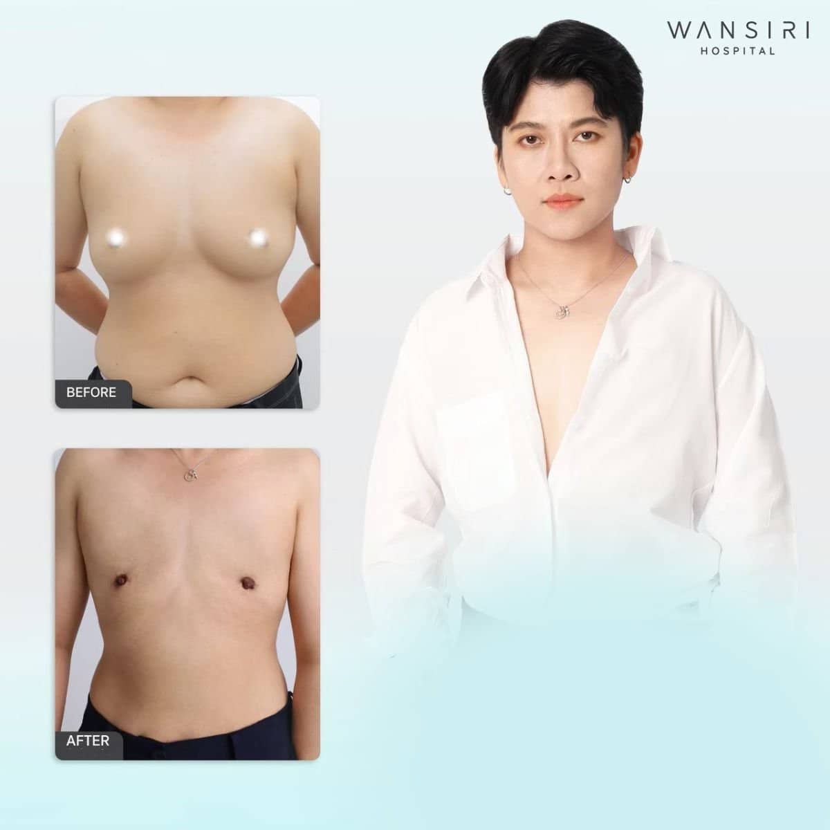 Case 17590 - top surgery