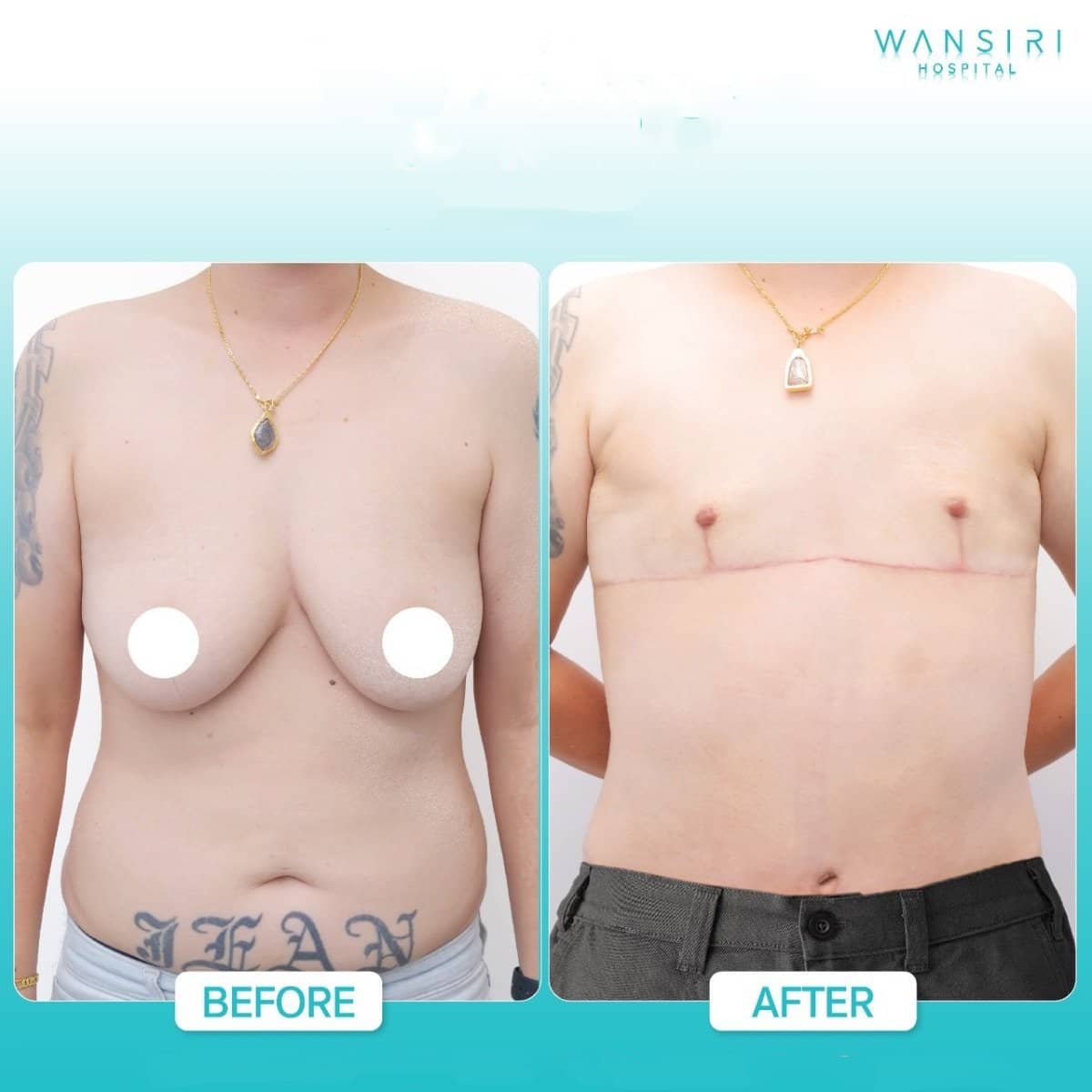 Case 17592 - top surgery