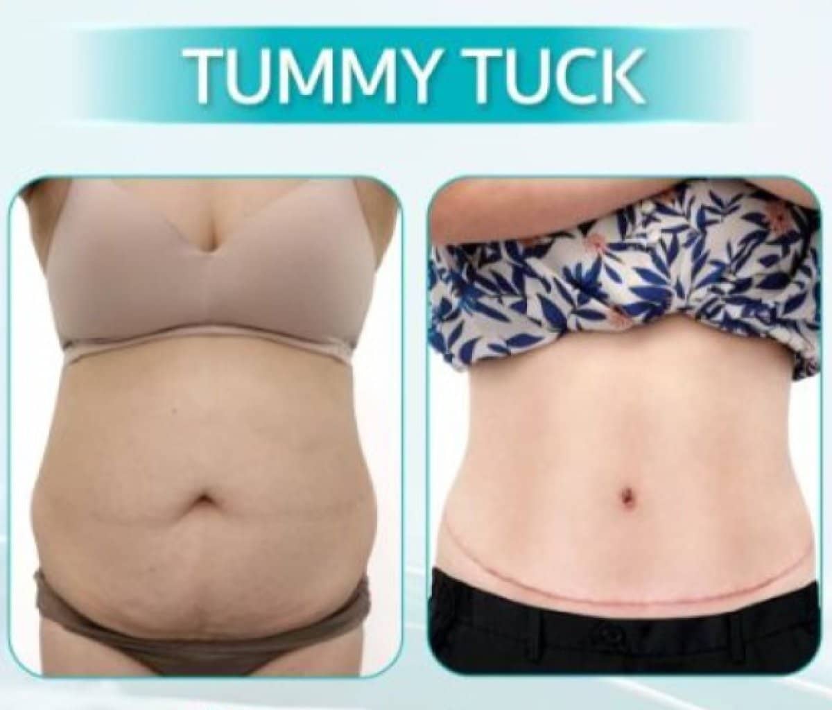 Case 17593 - tummy tuck