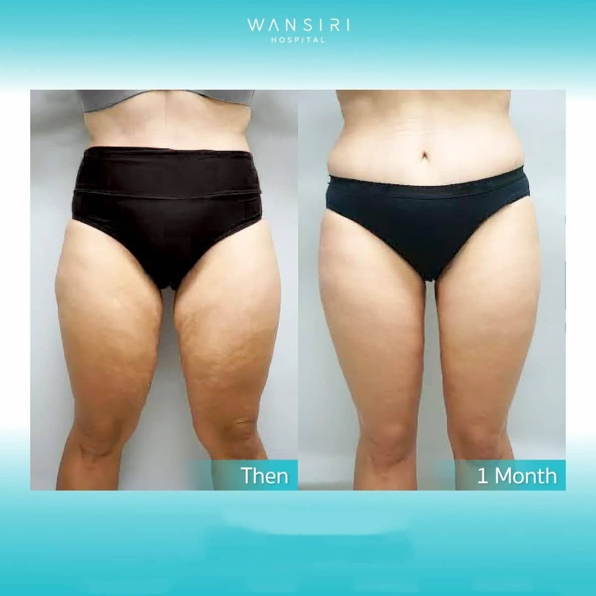 Case 17594 - thigh lift