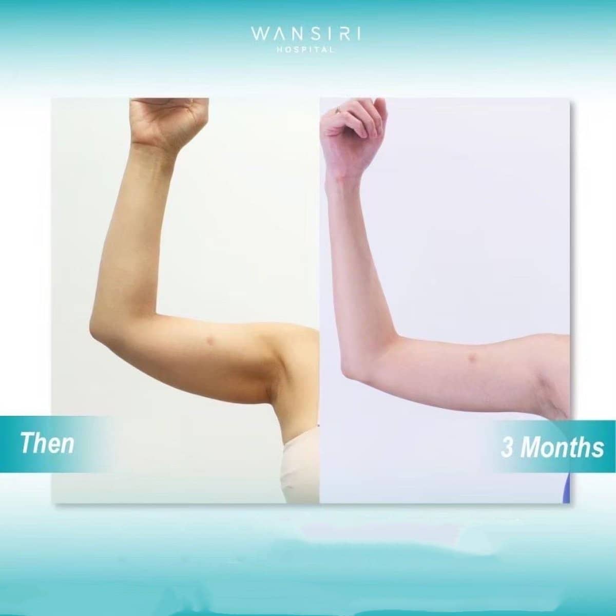 Case 17595 - arm lift